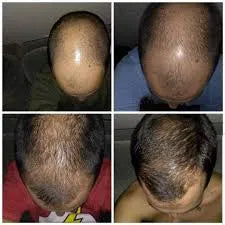 🧬Rolon Bodywise estimula el crecimiento de tu cabello con el efecto del romero